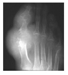 Big Toe With Gout X-ray