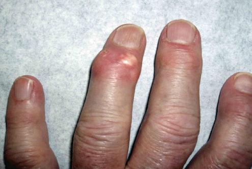 Gout In Fingers